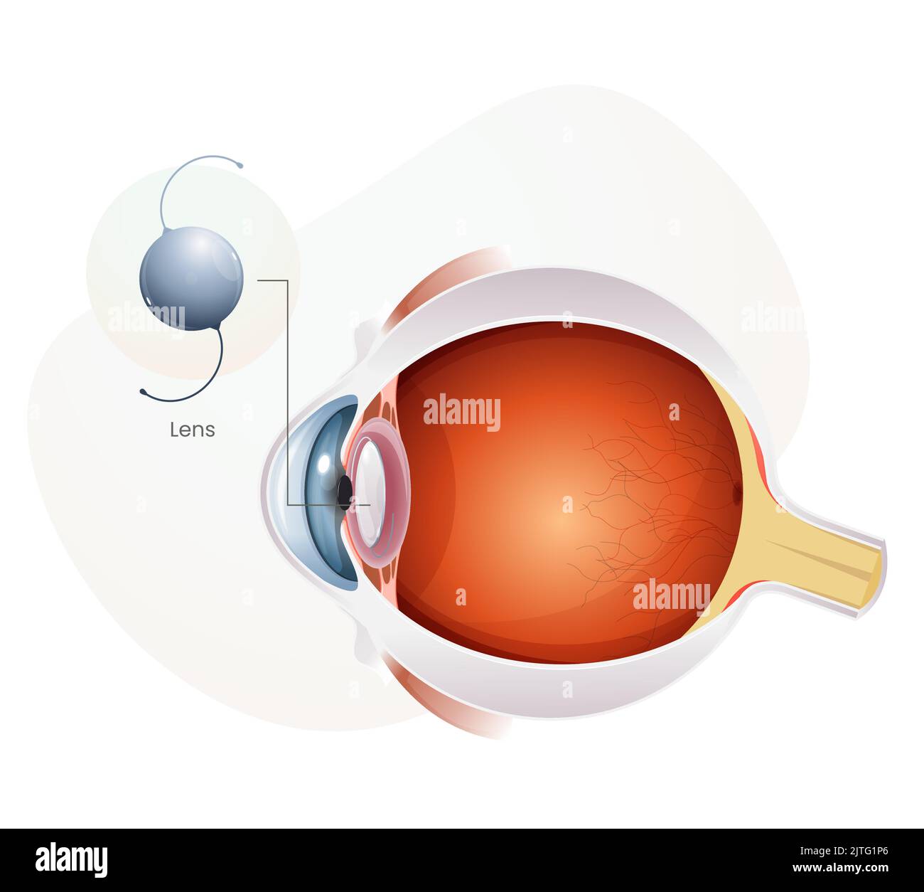 Intraocular Lens for Human Eye with Cataract - Illustration as EPS 10 File Stock Vector