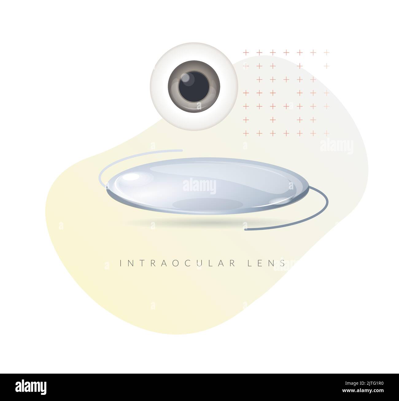 Human Eye - Cataract - Intraocular Lense- Illustration as EPS 10 File Stock Vector
