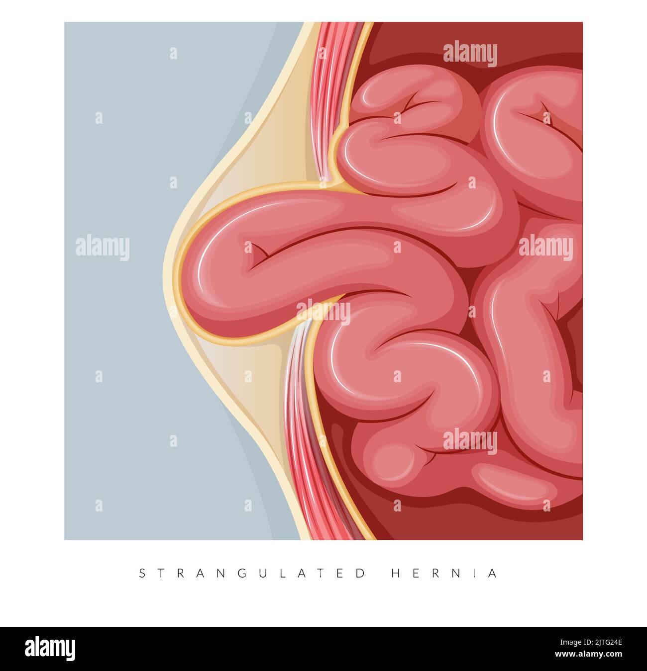 Strangulated Hernia - Section of the Small Intestines - Stock ...