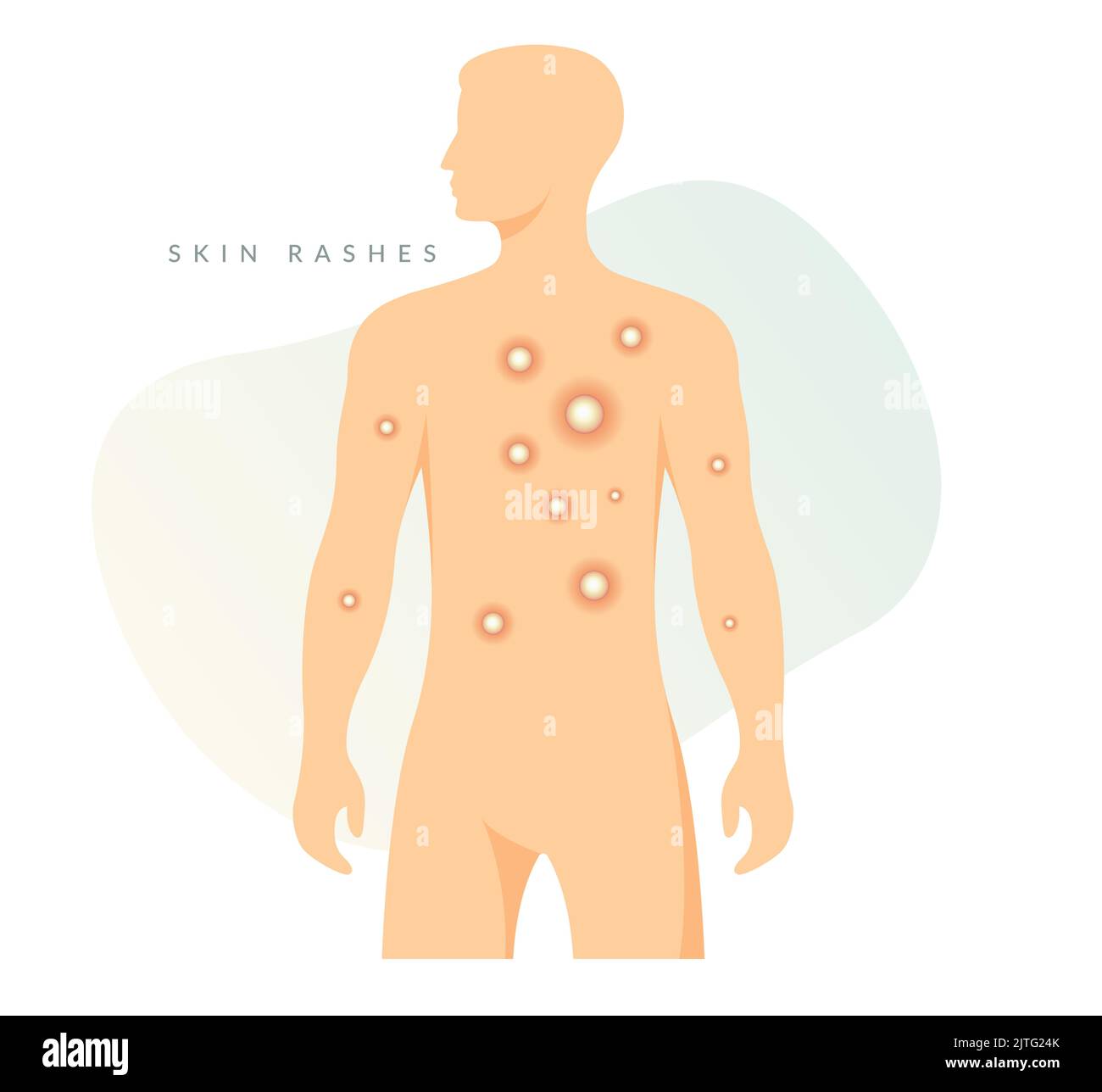 Monkeypox - Skin Rashes and Spots as Symptoms - Icon as EPS 10 File ...