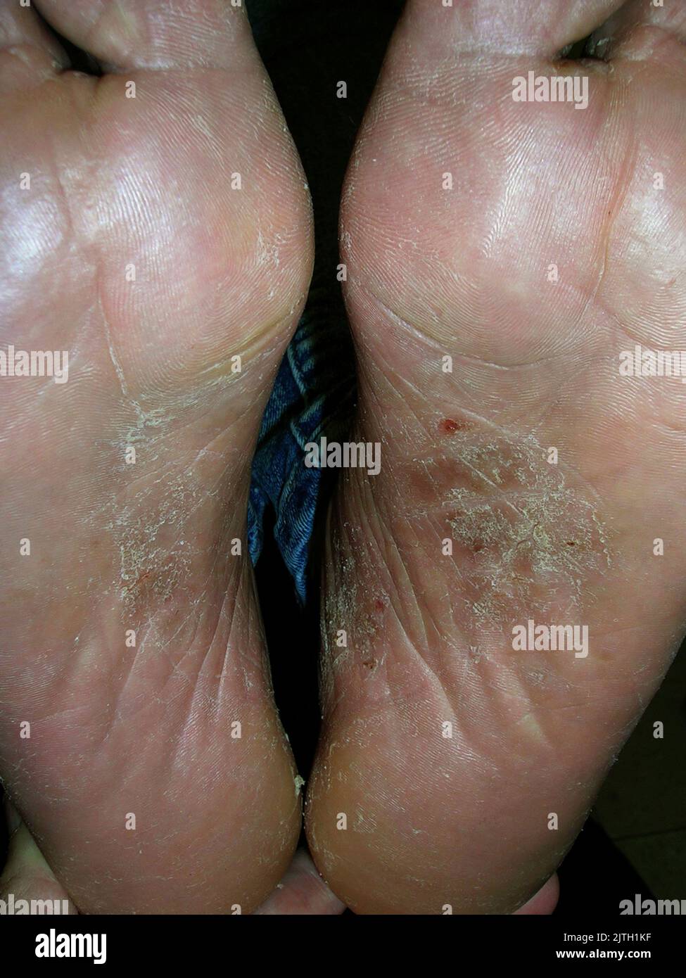 Atypical palmar plantar psoriasis Stock Photo - Alamy