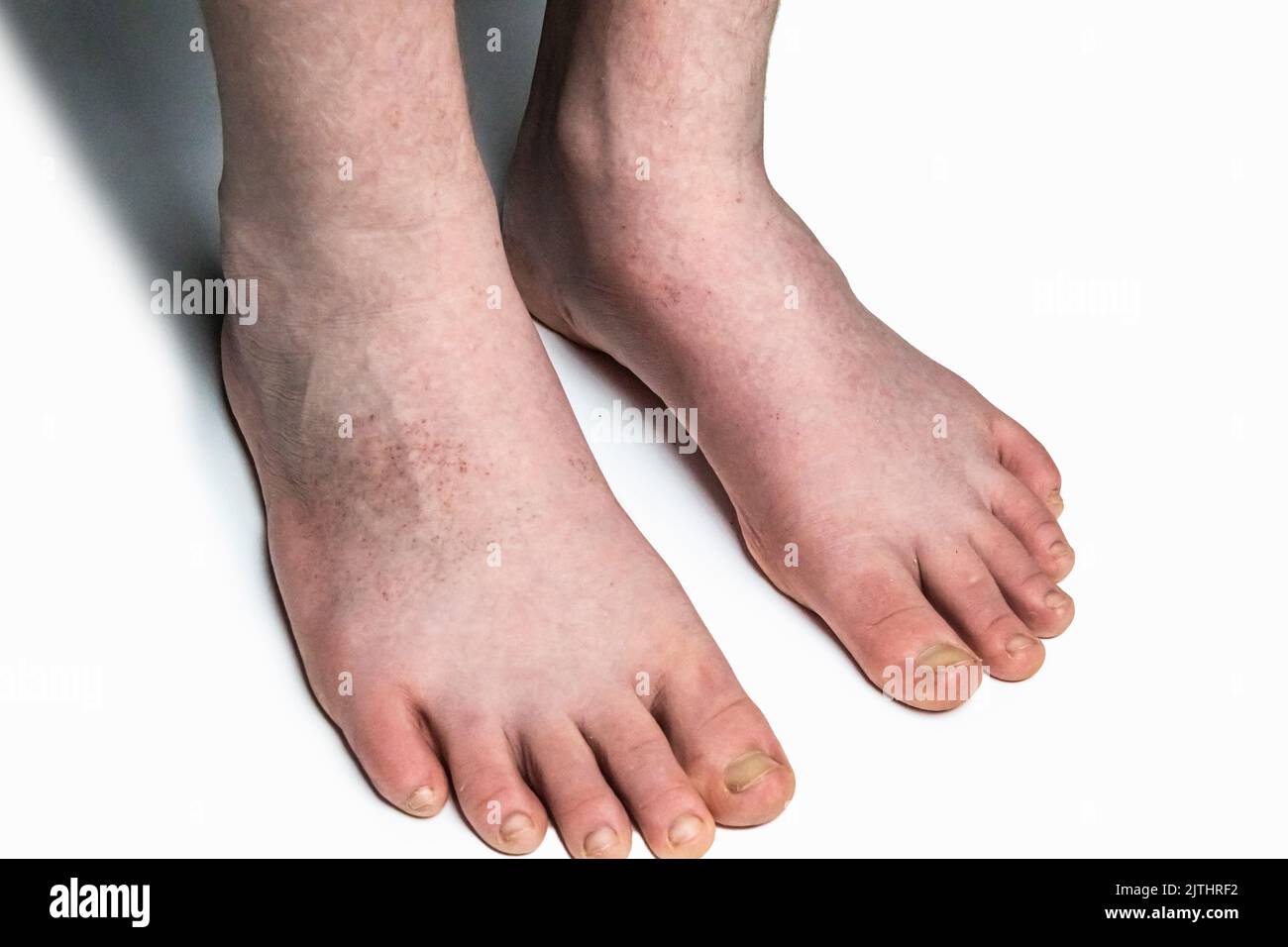 Skin with allergy,  food allergy, dermatitis, insect bites, irritation concept. A red rash on the feet of a male against  white background. Stock Photo