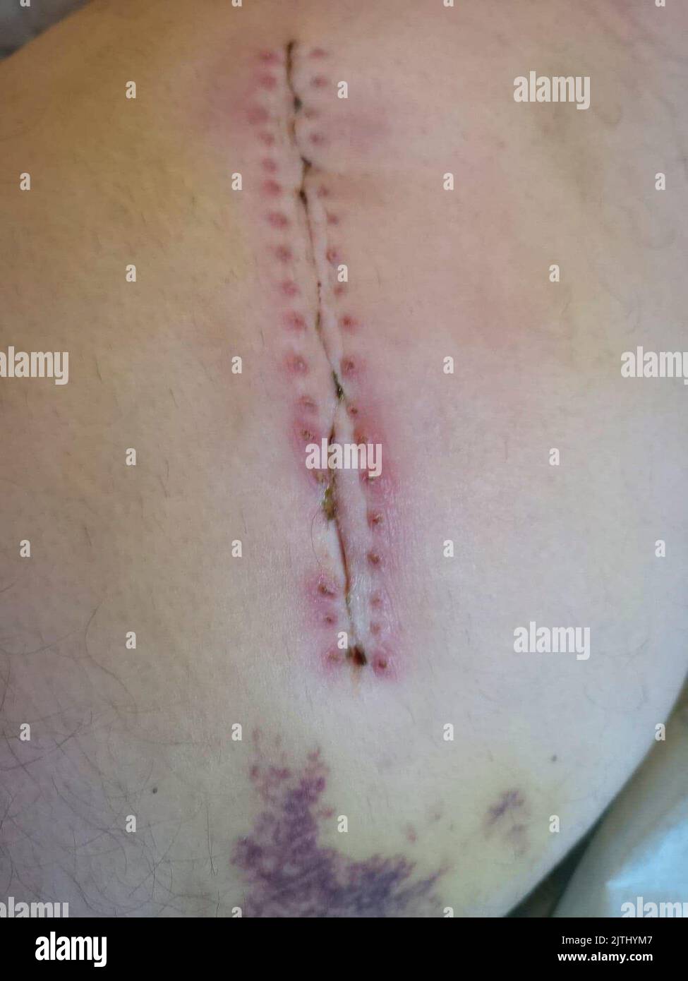 Will it hurt when my stitches are removed after surgery? (Video)