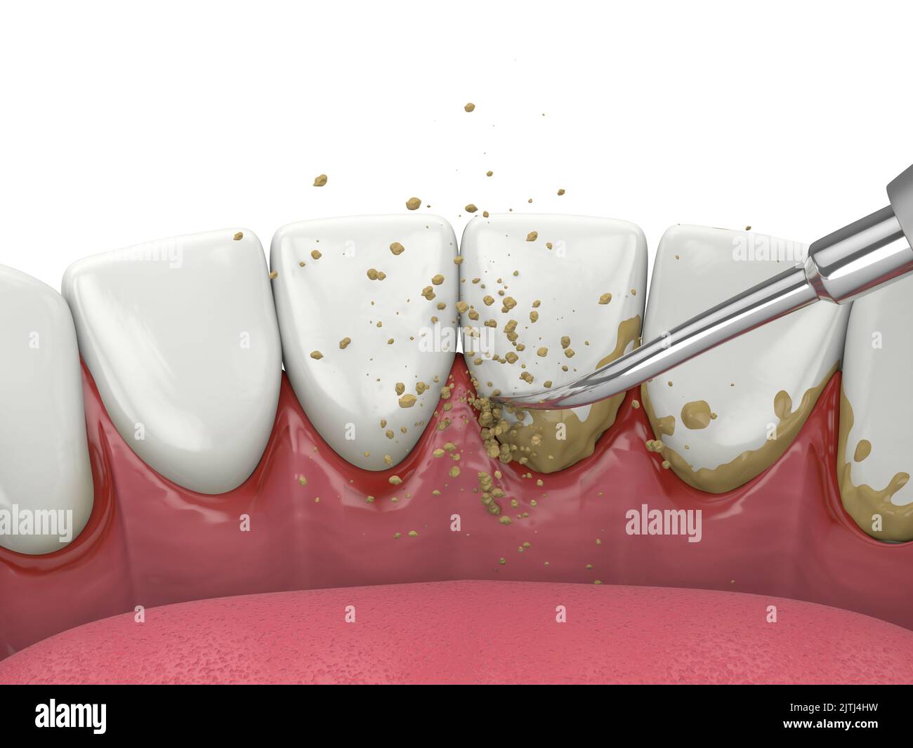 Removing tartar and plaque from teeth by ultrasonic scaler. Dental
