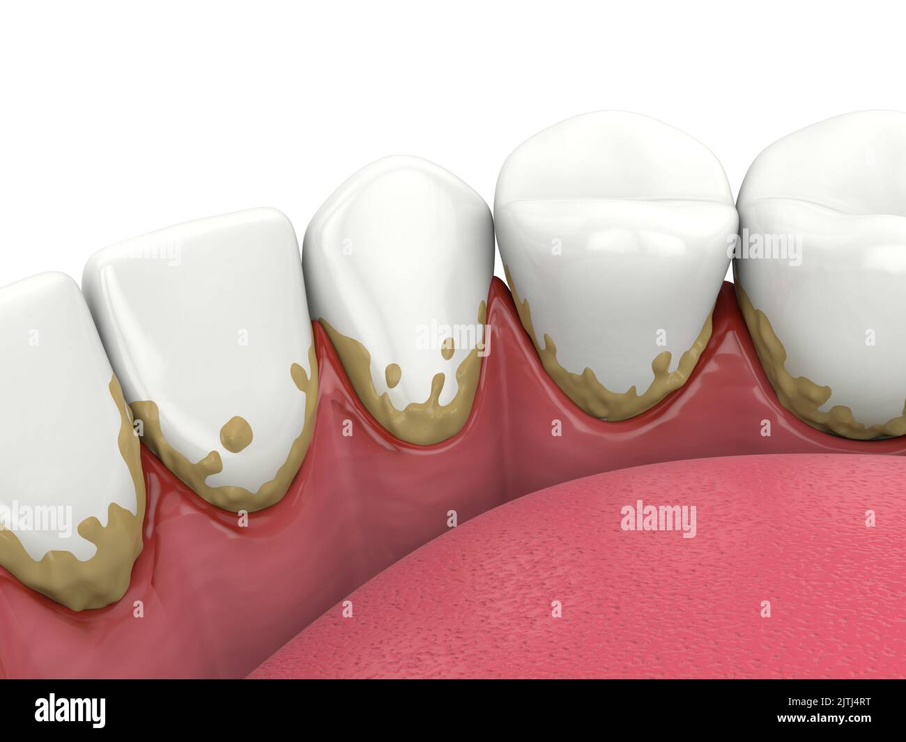 3d render of lower jaw with calculus buildup on teeth line and making ...