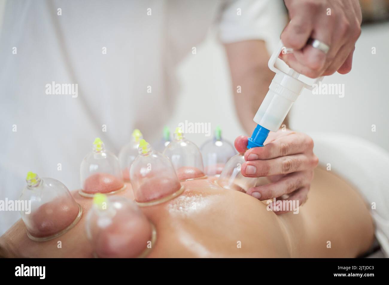 Glass multiple vacuum cup for medical cupping therapy on women's back. Ventosa traditional massage. Alternative Medicine. Medical health care Stock Photo