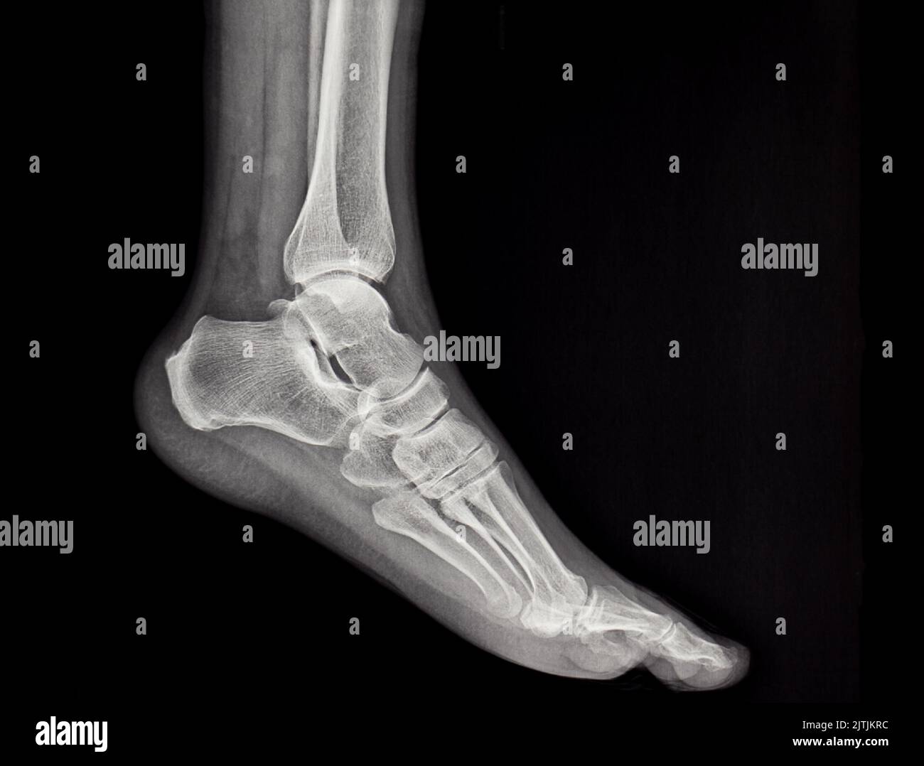 An Xrays of the human foot, bones, clinic, xray Stock Photo Alamy