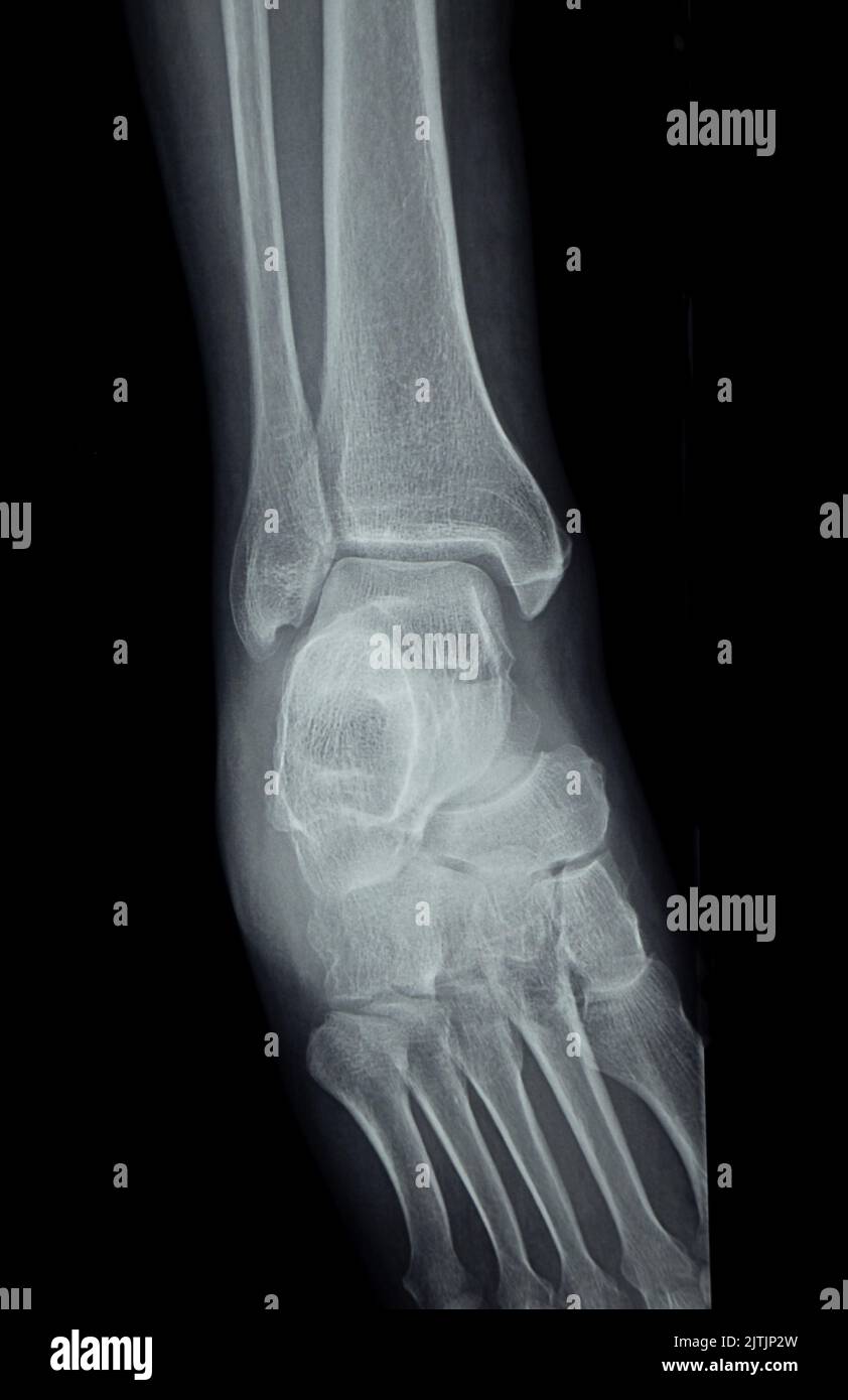 An Xrays of the human foot, bones, clinic, xray Stock Photo Alamy