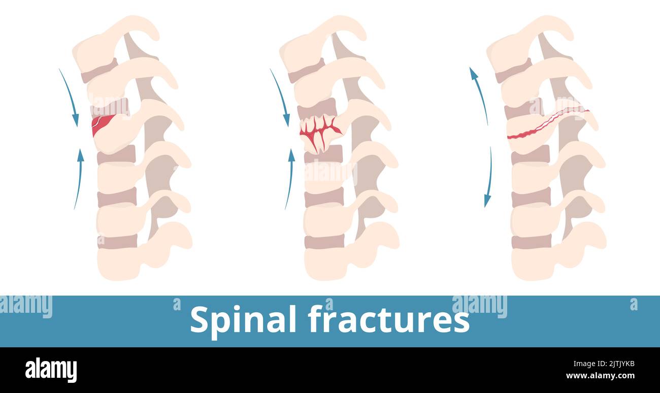 Spinal fractures. Types of spinal fractures depend on damage direction. Fracture of the vertebrae (backbone) caused from injury, trauma, fall, sport Stock Vector