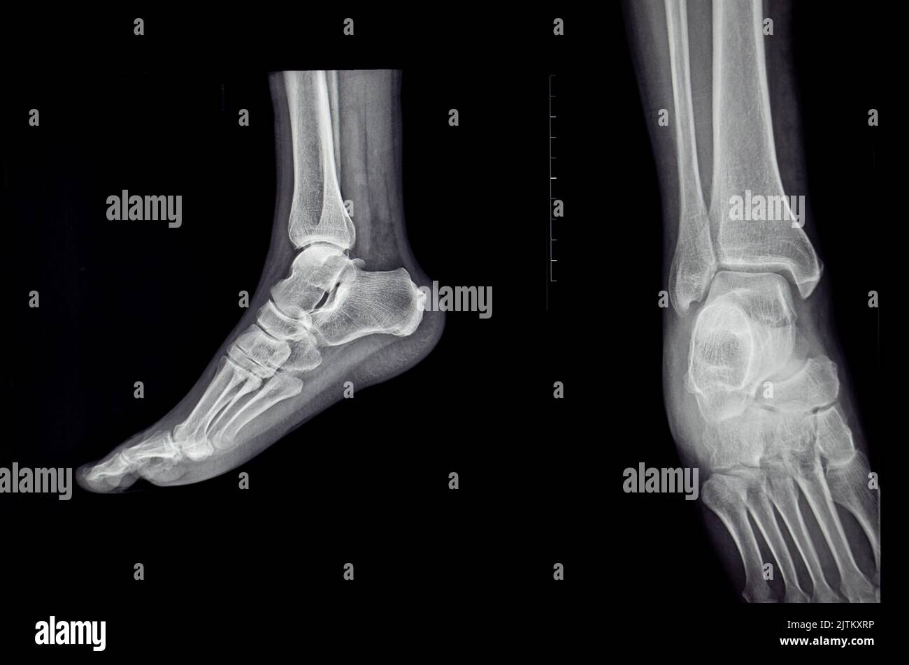 an xray of the sole of the human foot, medical, bones Stock Photo Alamy