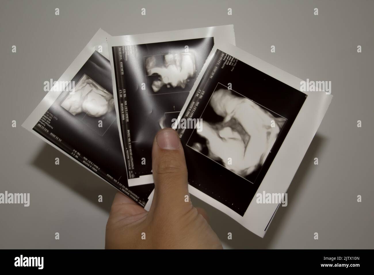 ultrasound picture of baby still inside the belly Stock Photo - Alamy
