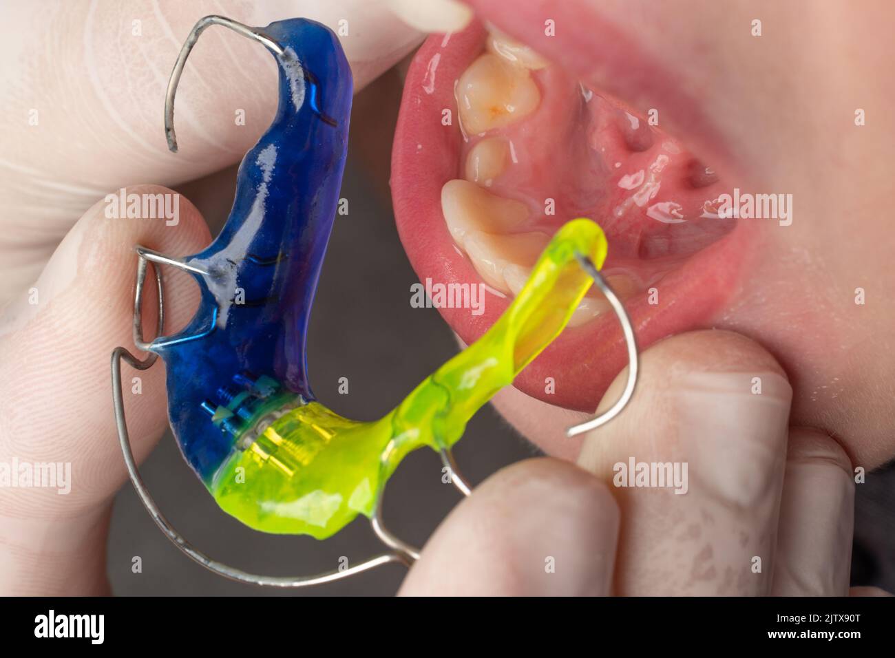 Plate for lower teeth, orthodontist and plate for teeth of the lower