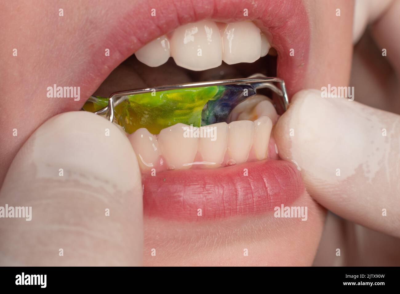 The orthodontist puts a plate on the lower teeth, a visit to the