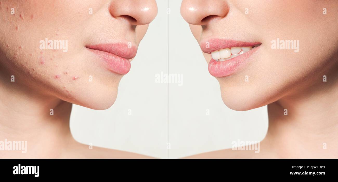Teenage girl before and after acne treatment Skin care concept. Acne