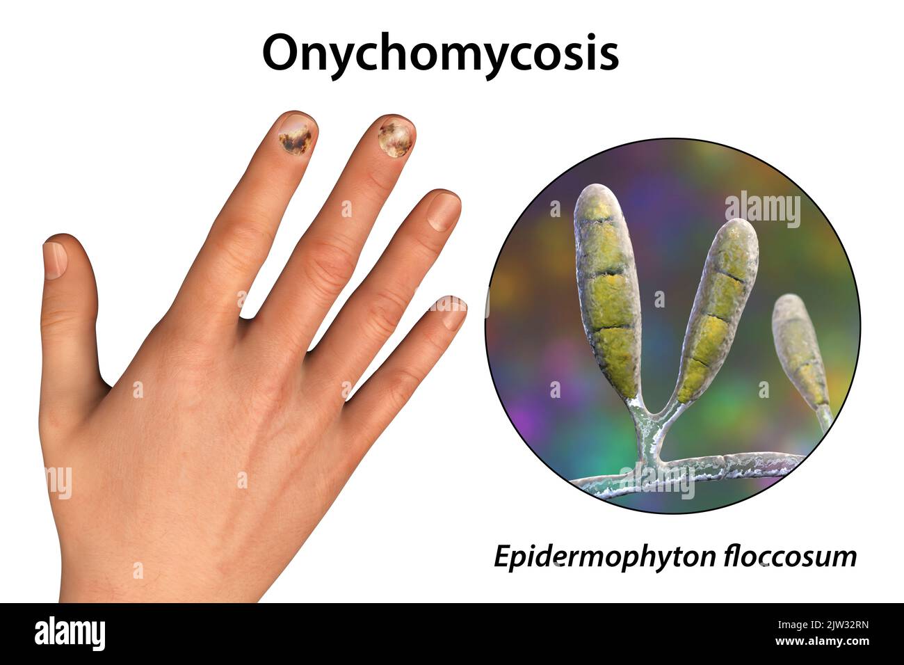 Illustration of a fungal nail infection showing a human hand with onychomycosis and a close-up view of Epidermophyton floccosum fungi, one of the causative agents of nail infections. Stock Photo