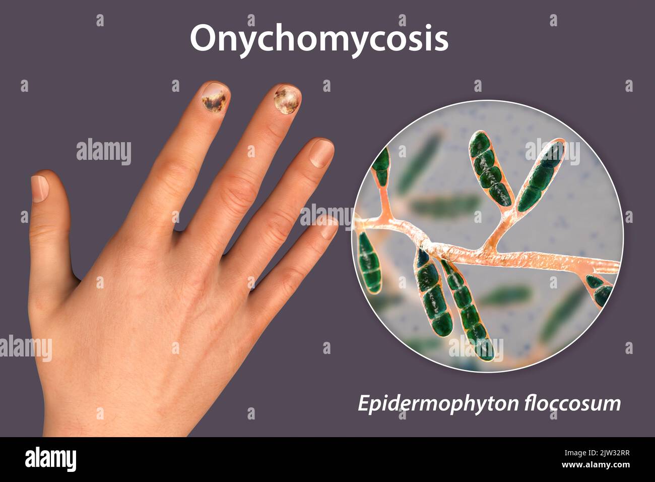 Illustration of a fungal nail infection showing a human hand with onychomycosis and a close-up view of Epidermophyton floccosum fungi, one of the causative agents of nail infections. Stock Photo