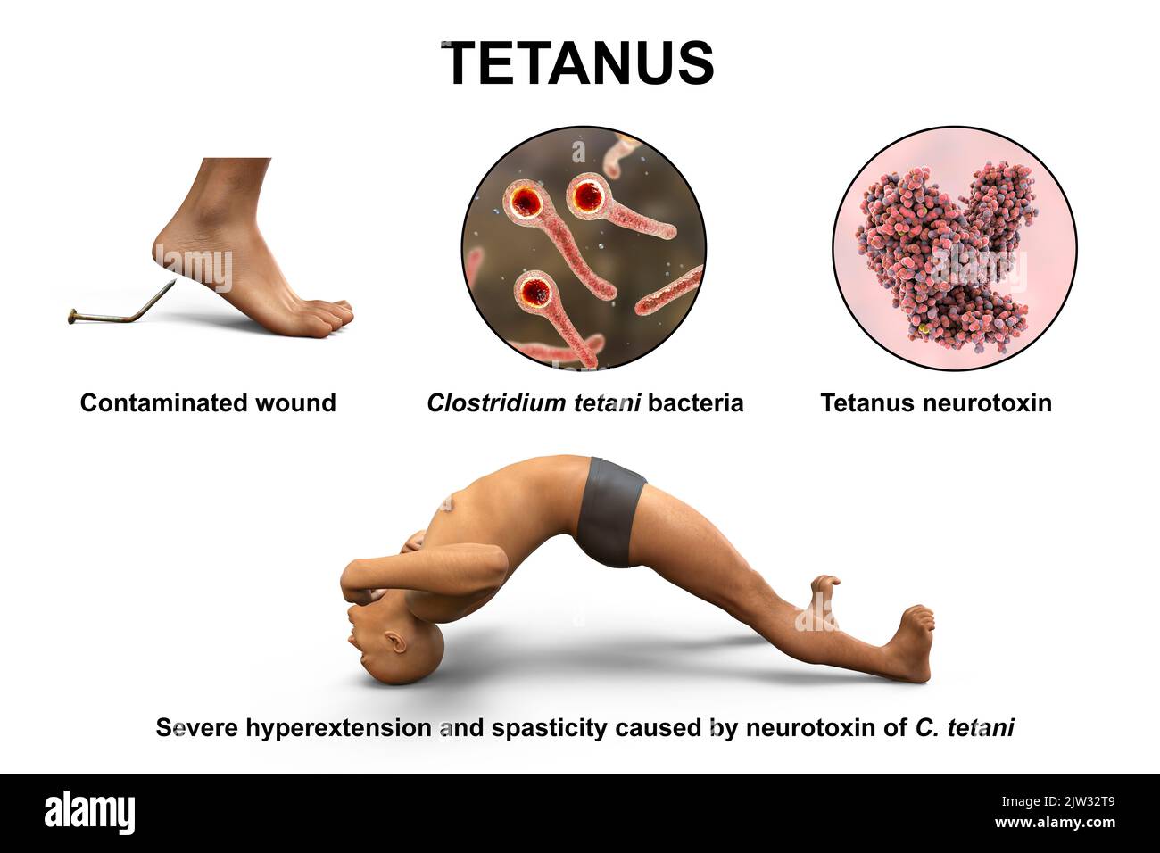 Mechanism of tetanus disease, illustration. A skin wound is contaminated with Clostridium tetani bacteria that produce a neurotoxin that reaches the spinal cord and causes spastic paralysis. The man is in opisthotonus (backward spasm), a state of severe hyperextension and spasticity. Stock Photo