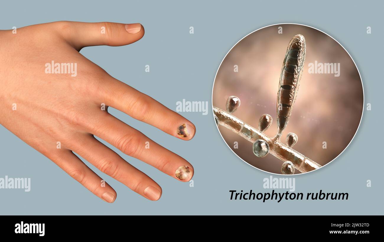 Illustration of a fungal nail infection showing a human hand with onychomycosis and a close-up view of Trichophyton rubrum fungi, one of the causative agents of nail infections. Stock Photo