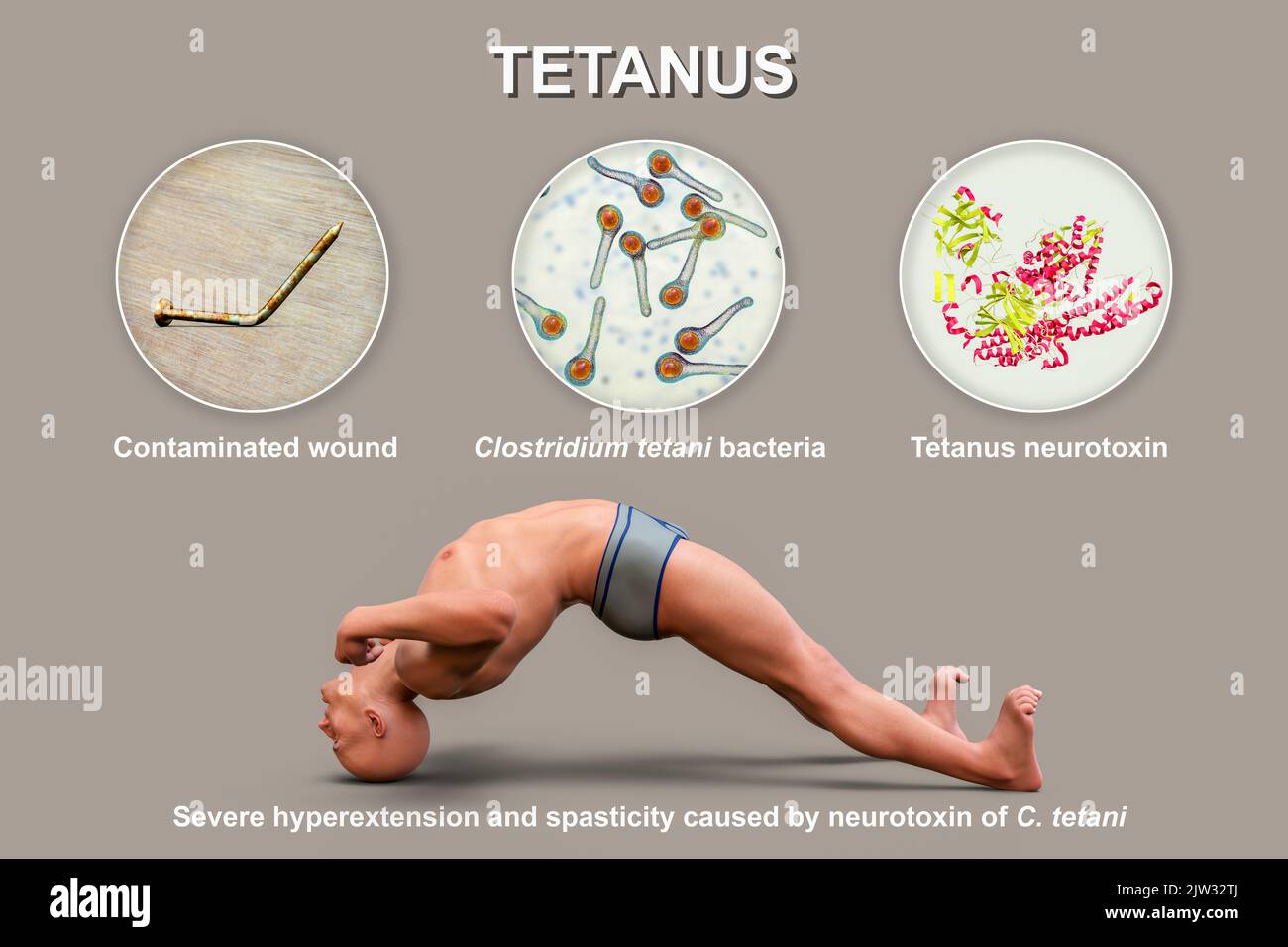Mechanism of tetanus disease illustration a skin wound is