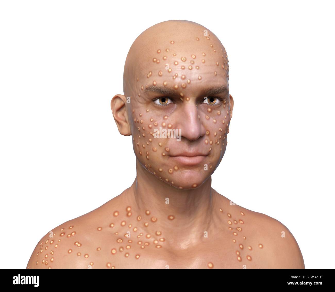 Smallpox Skin Lesions Mopasolar
