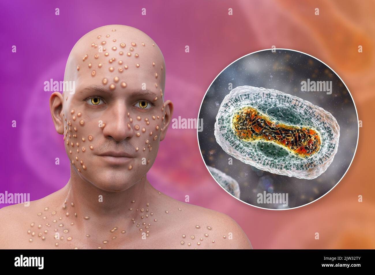 Tanapox virus hires stock photography and images Alamy
