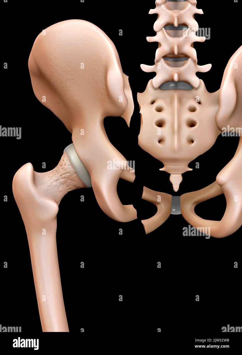 Illustration showing rear view of a fractured pelvis Stock Photo Alamy