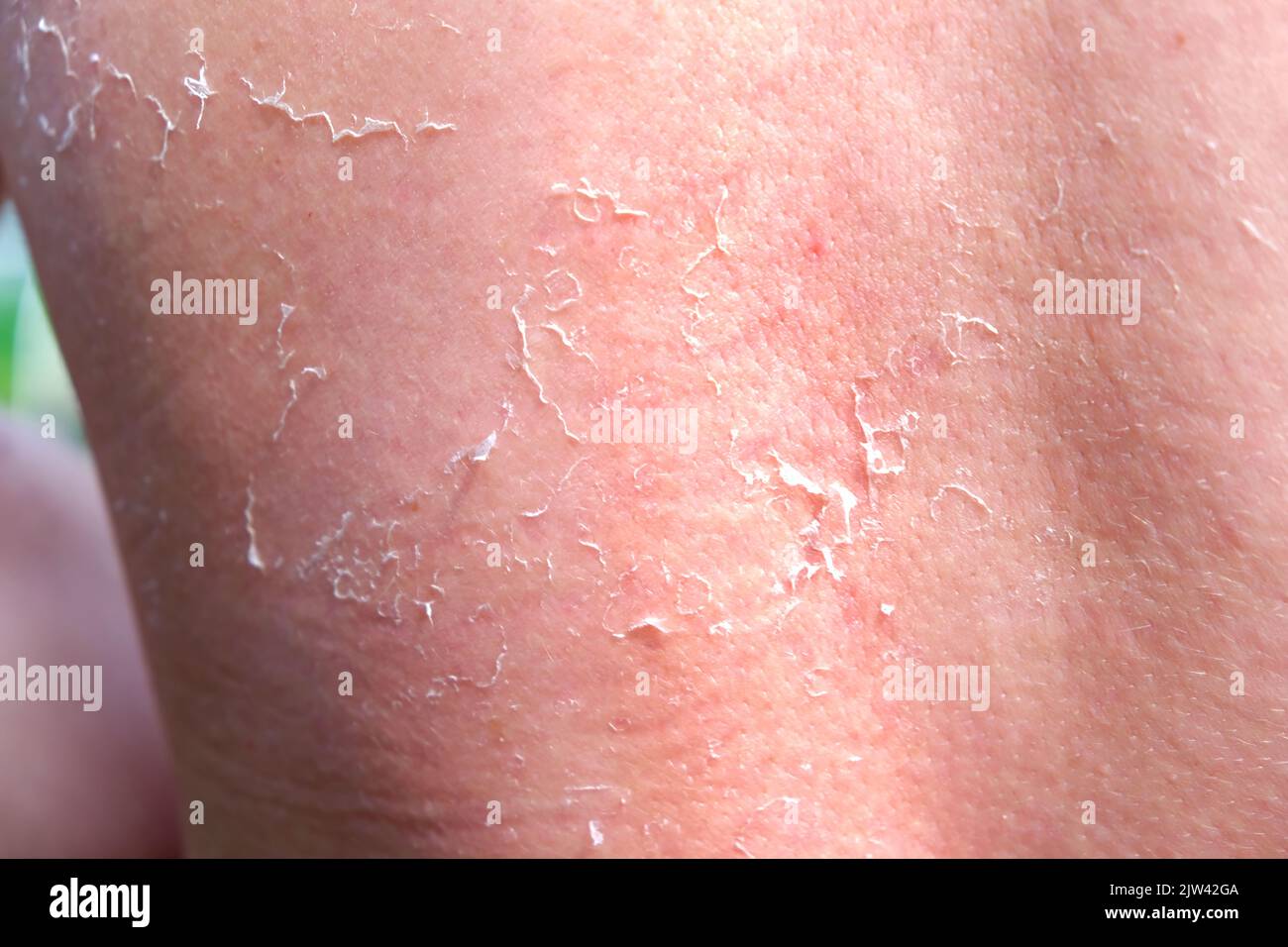 The man received sunburn on the seashore. The skin peels off. Protection of the skin from the sun. Stock Photo