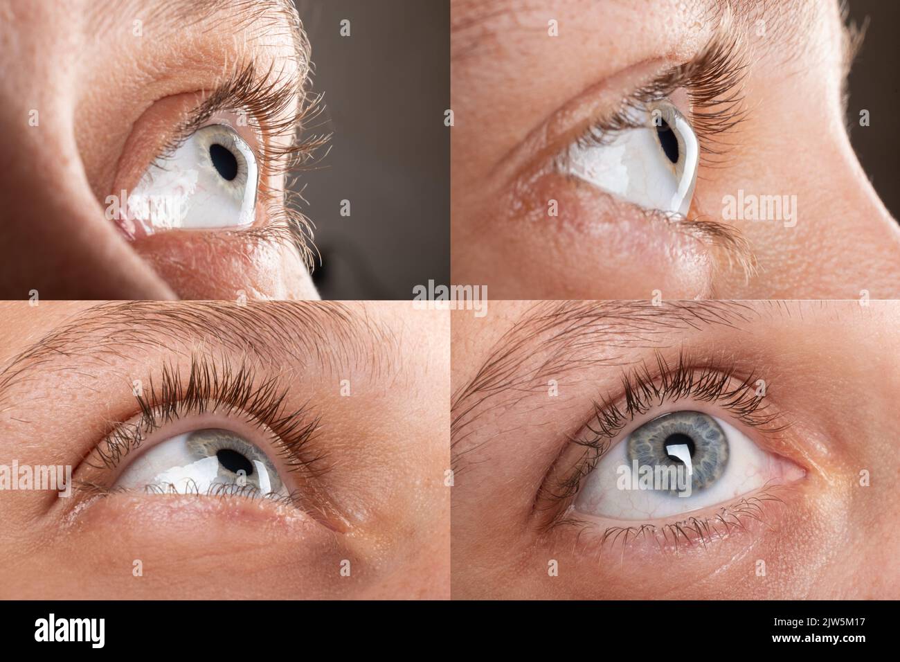 woman eye with corneal dystrophy, keratoconus, thinning of the cornea. Stock Photo