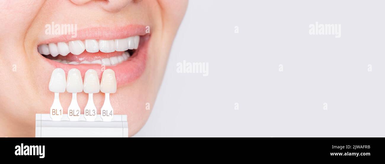 Banner Tooth Whitening Perfect White Teeth Close Up With Shade Guide