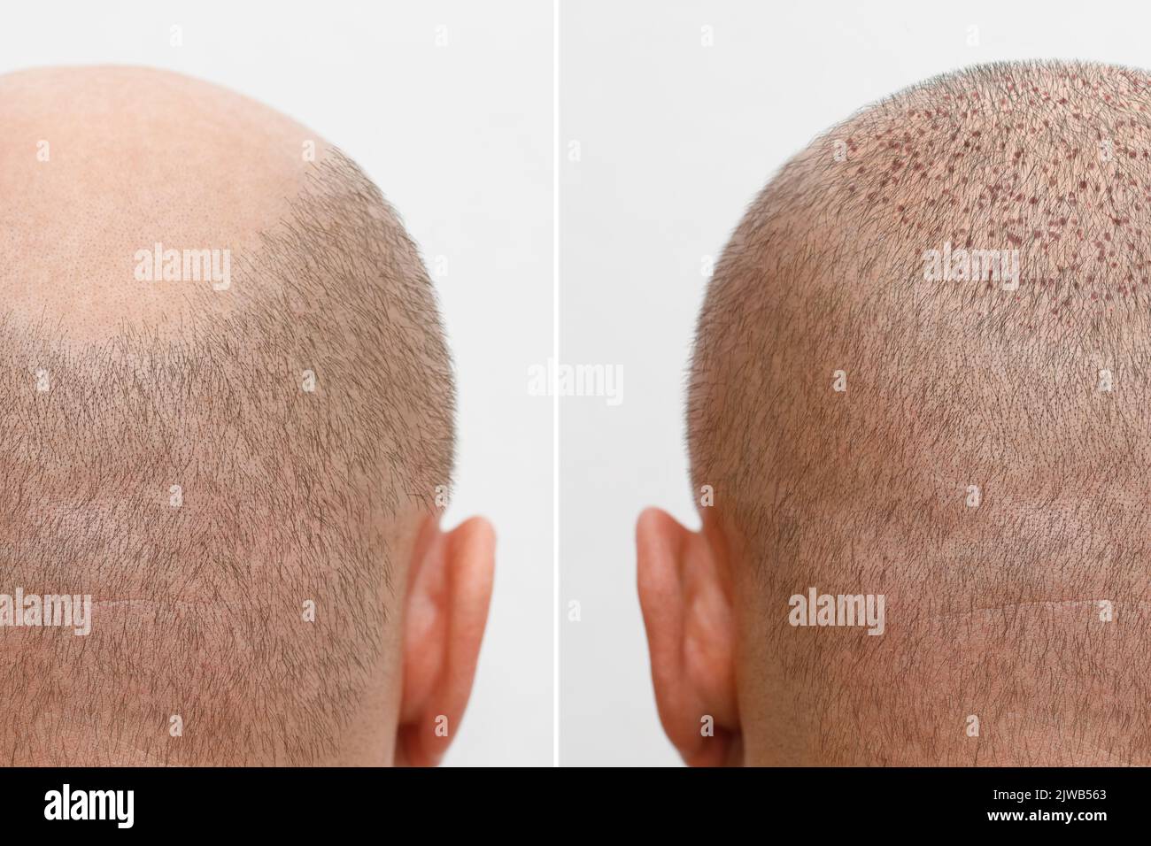 The head of a balding man before and after hair transplant surgery. A man losing his hair has become shaggy. An advertising poster for a hair Stock Photo