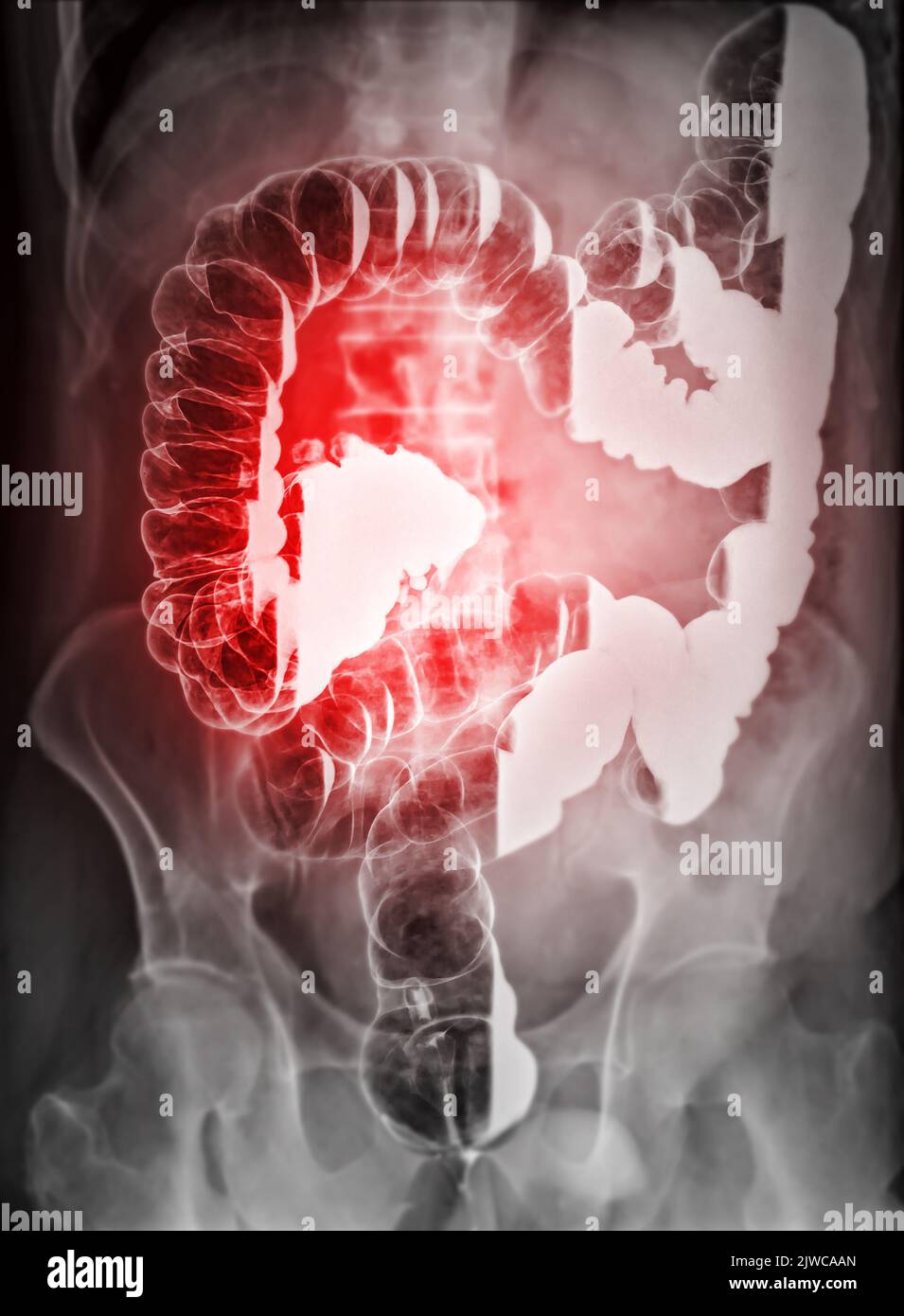 Barium enema or BE is image of large bowel after injection of barium