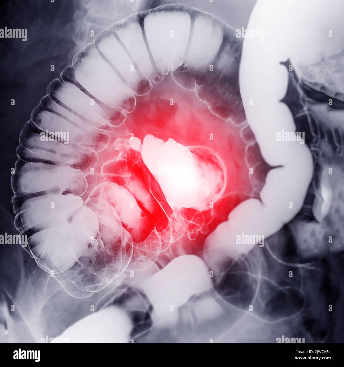 Barium enema or BE is image of large bowel after injection of barium contrast fill into colon
