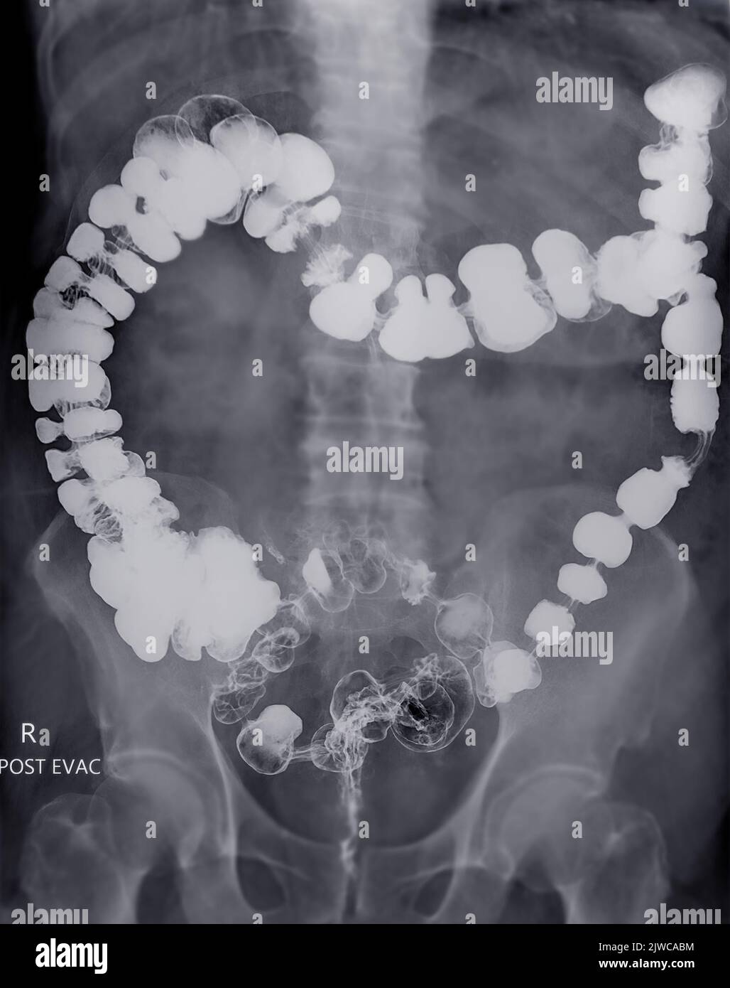 Barium enema or BE is image of large bowel after injection of barium contrast fill into colon