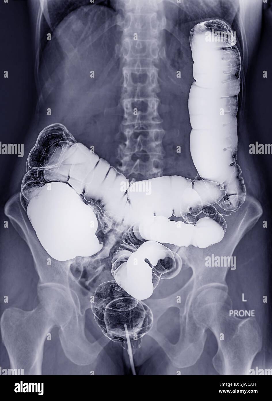 Barium enema or BE is image of large bowel after injection of barium contrast fill into colon under fluoroscopic control isolated on white background Stock Photo