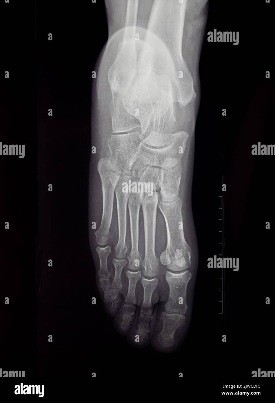 A closeup xray of the sole of the human foot, examination, medical