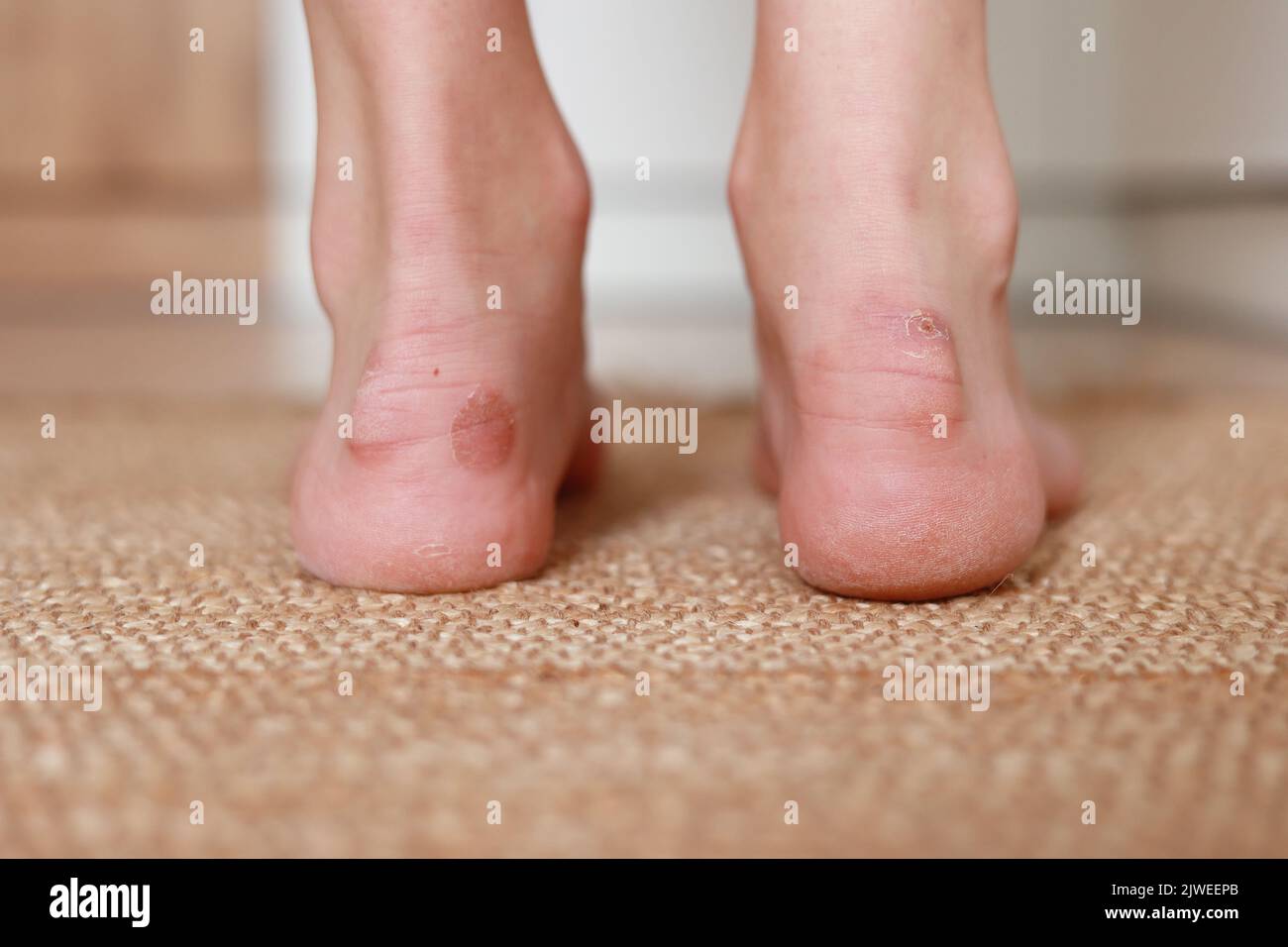 Callus blisters on woman feet. Painful wounds. shoes problems. View of foot with