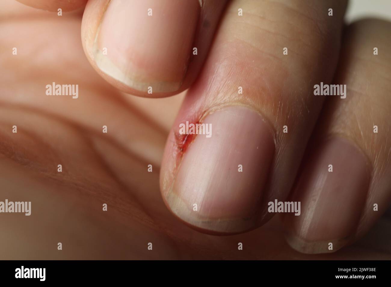 damaged finger with wound inflammation closeup. diseases of nails and