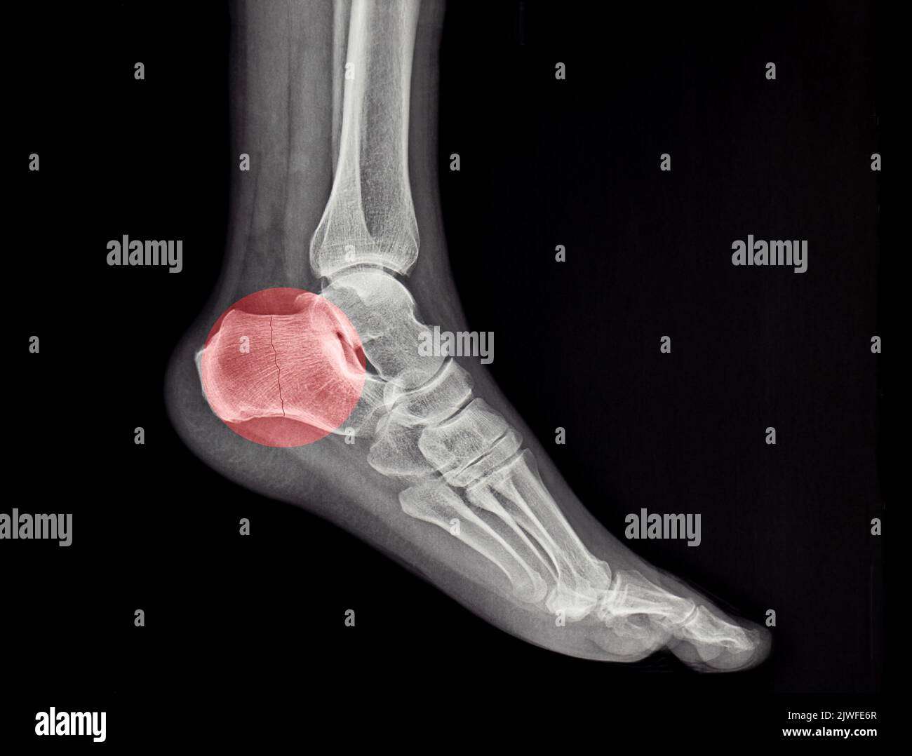 an xray of a human calcaneus fracture, foot, leg Stock Photo Alamy