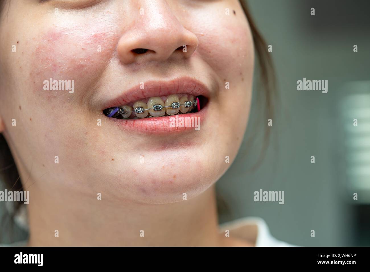 Braces in teenage girl mouth to treat and beauty for increase
