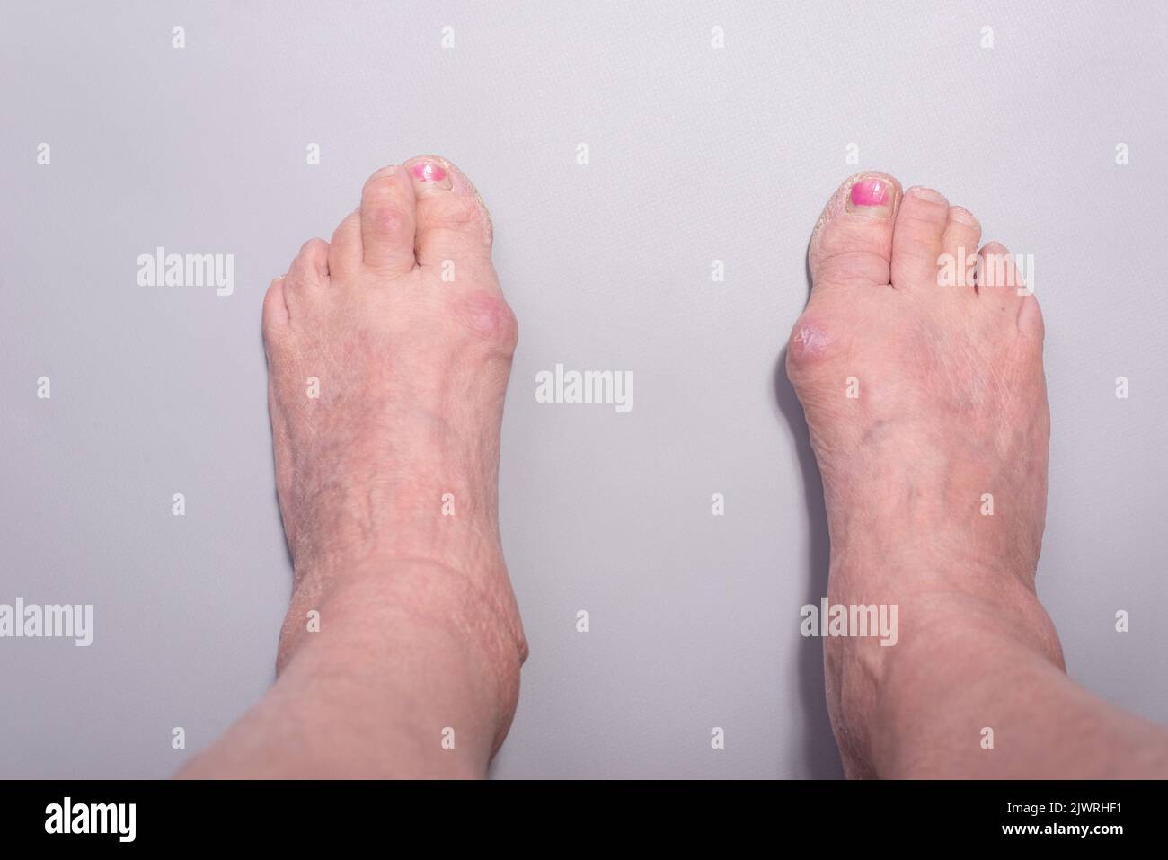 close-up of big toe disease curvature in elderly woman on gray background. Stock Photo