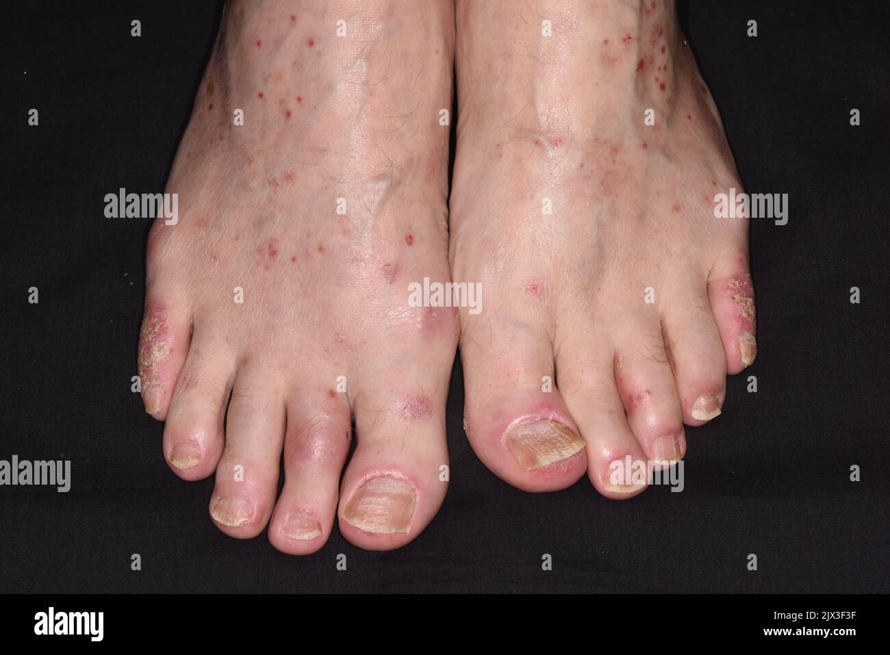 Psoriasis on the feet of a 66 year old male patient Psoriasis is a