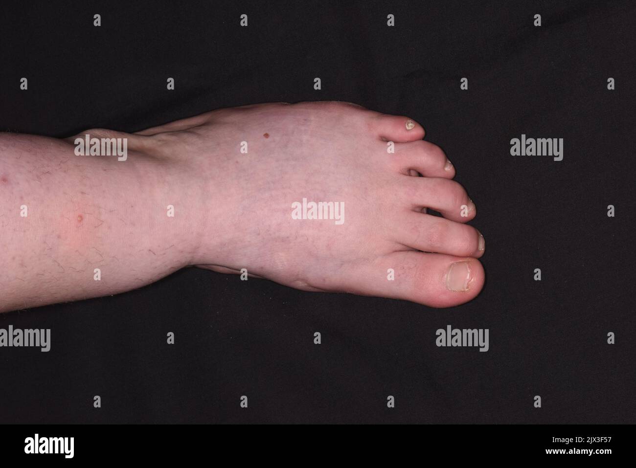 Distortion of the foot of a 24 year old female patient following