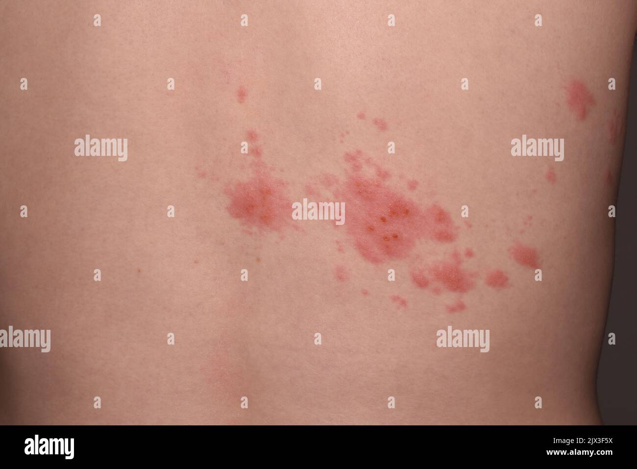 Shingles rash and lesion on the back of a 19 year old male patient ...