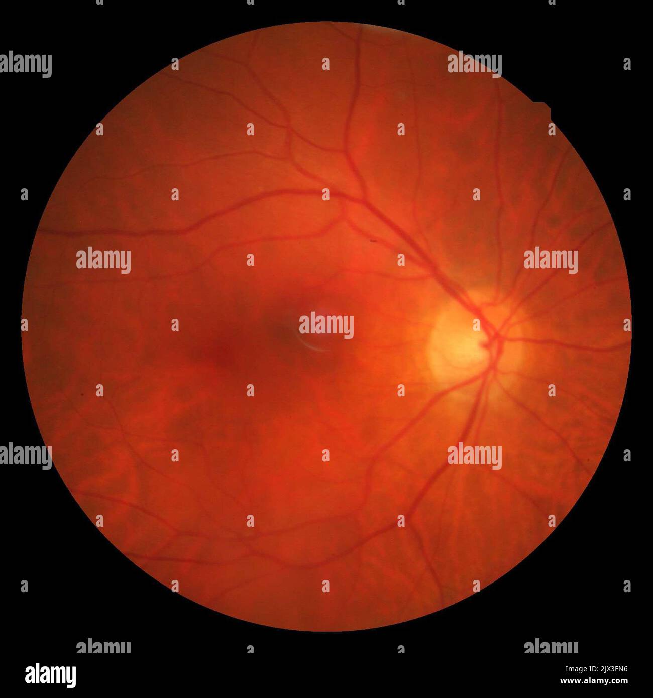 View of the fundus of the eye the inside, back surface of the eye. The
