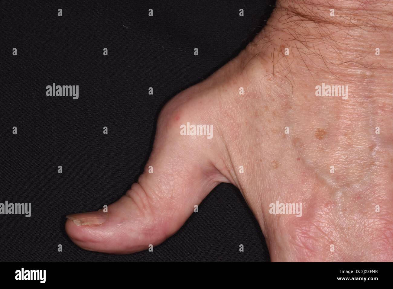 Psoriatic arthritis of the hands, showing the deformed thumb of a 66