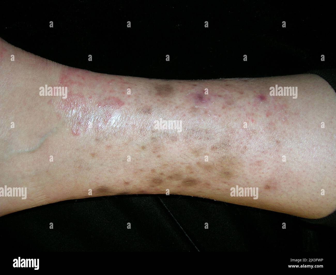 Rash on the leg of a 50 year old Hispanic female patient with Majocchi