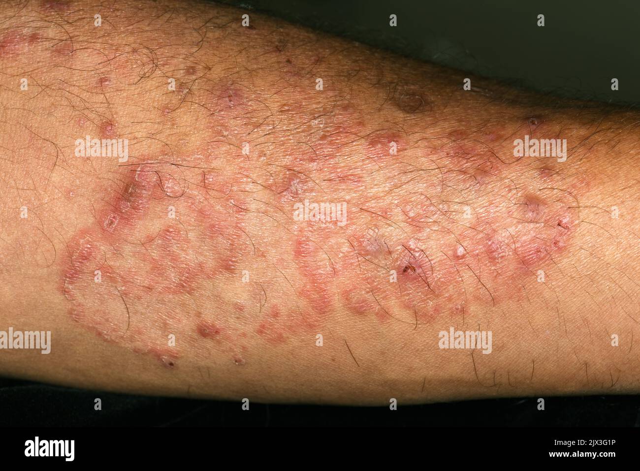 Rash on the limb of a 50 year old Hispanic male patient with Majocchi's