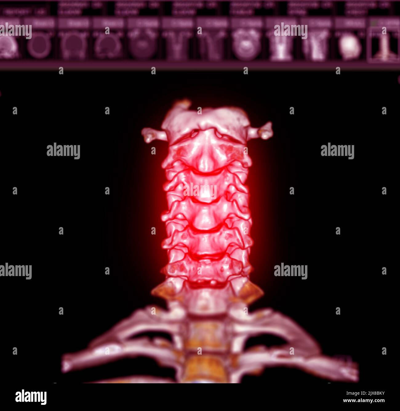 CT SCAN of Cervical Spine ( C-spine ) patient trauma case 3D rendering image . Stock Photo