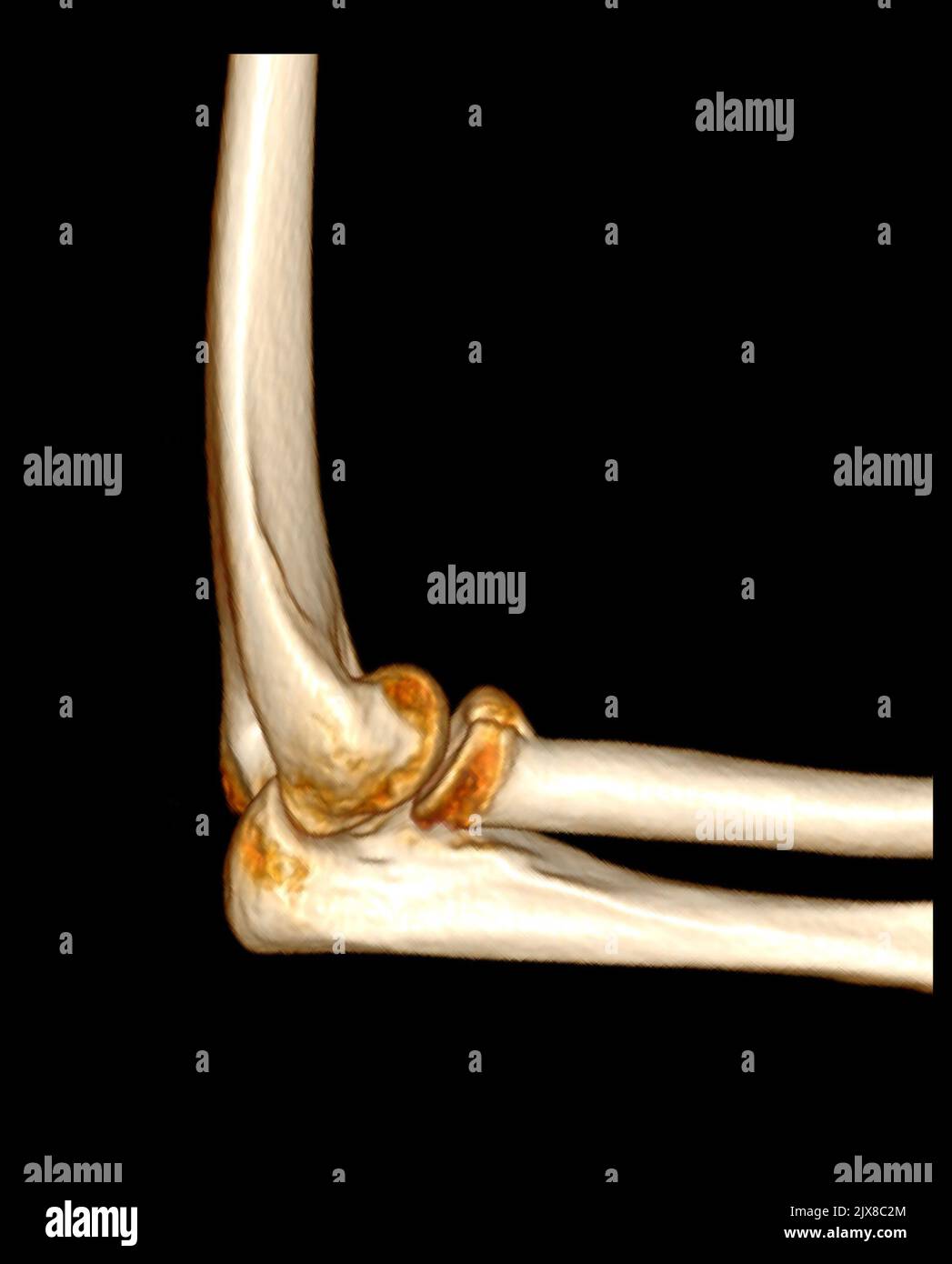 Computed Tomography Volume Rendering examination of elbow joint 3D