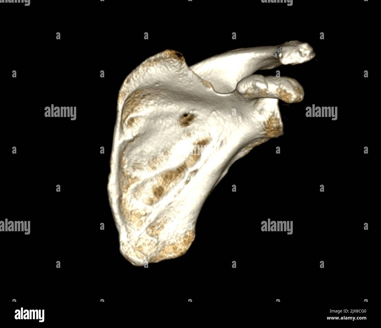 Computed Tomography Volume Rendering examination of the Shoulder 3D ...